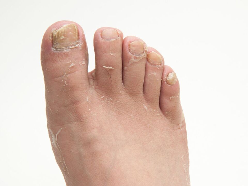 Champignon sur la peau des jambes et son traitement avec la crème ZXCVBNQWORT