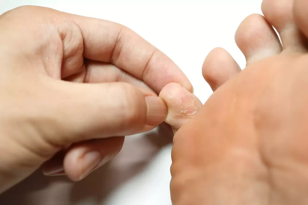 Champignon sur les doigts et son traitement avec la crème ZXCVBNQWert avec crème