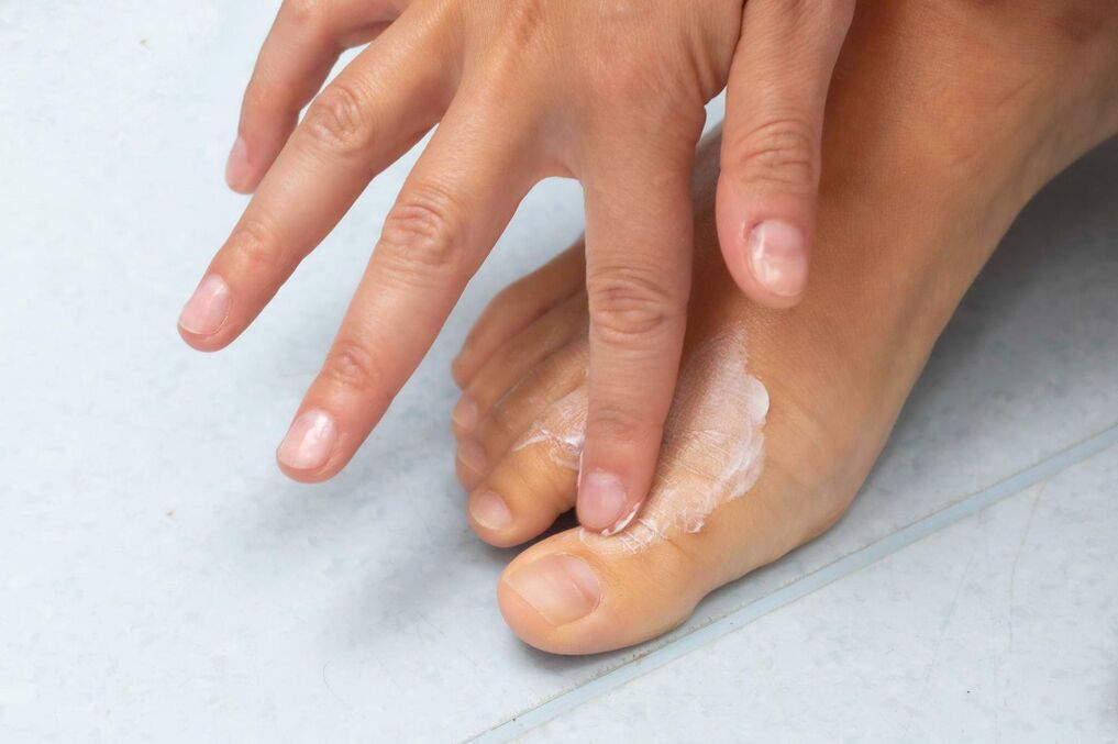 Crème démyxil du champignon entre les doigts des pieds