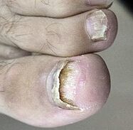 Champignon de l'ongle lancé