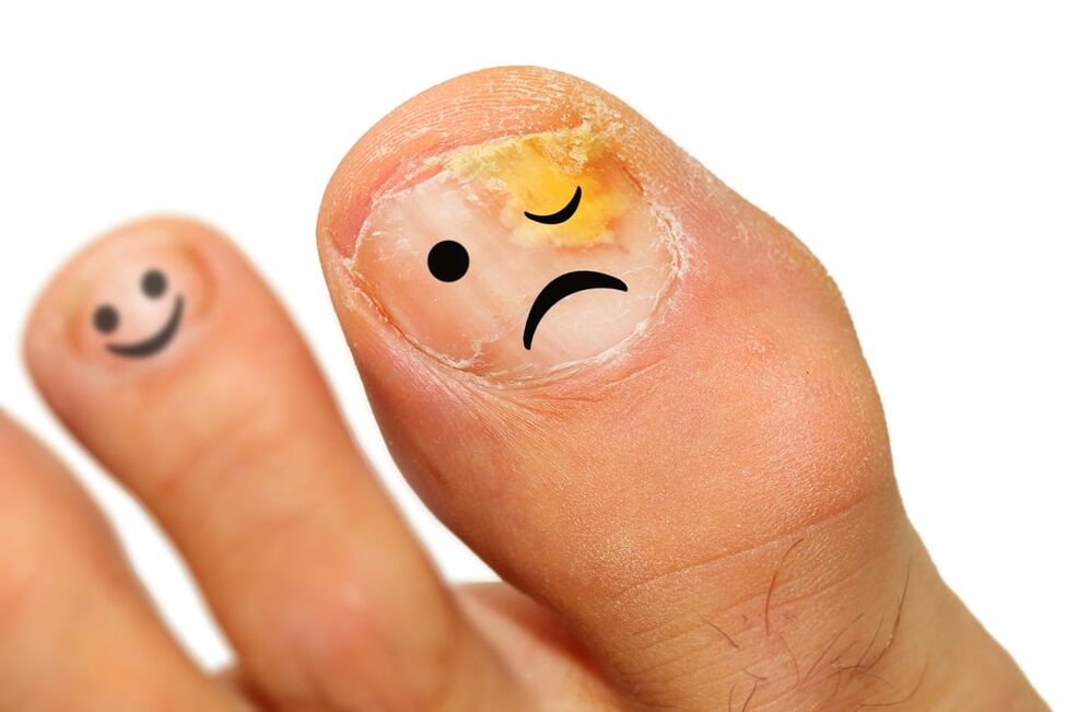 champignon sur l'ongle
