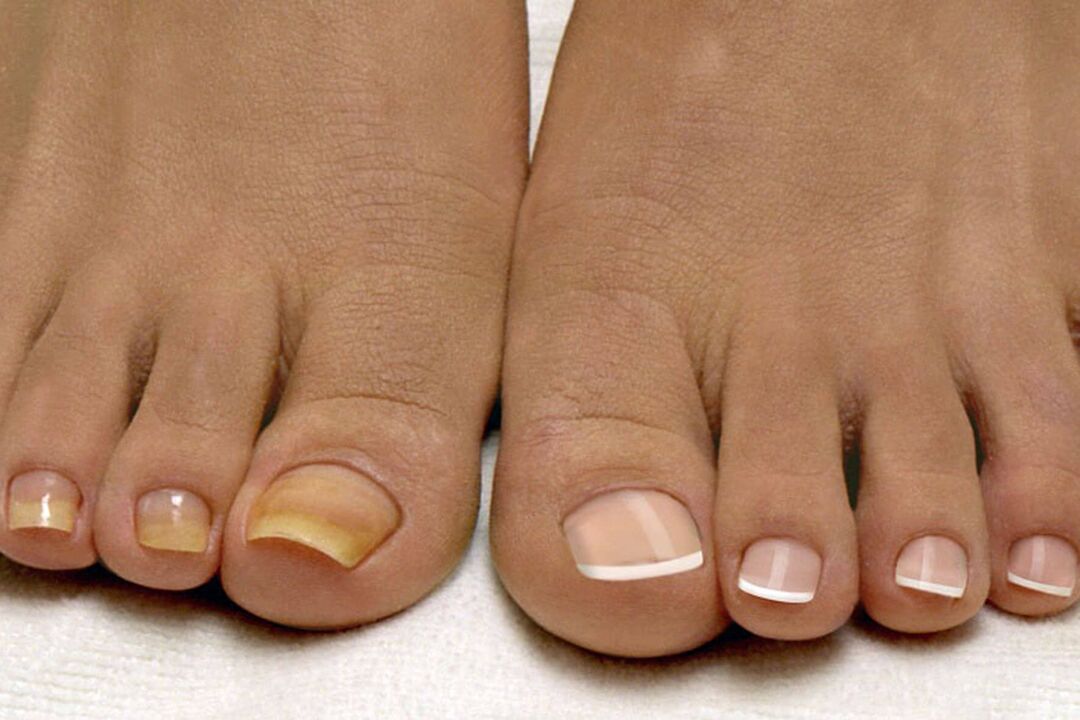 Sur des ongles sains d'une jambe, de l'autre avec un champignon