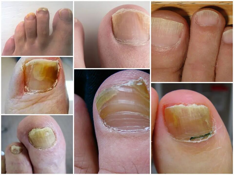 Premiers stades de la mycose des ongles des pieds