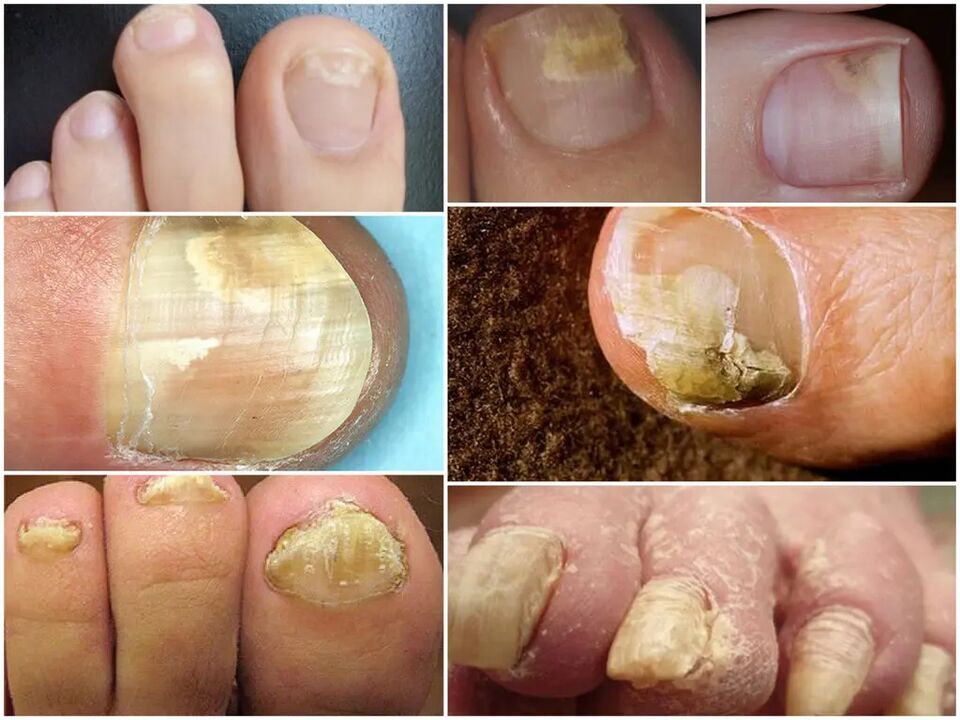 Étapes de développement du champignon des ongles des pieds