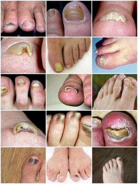 Infection fongique de la plaque à ongles