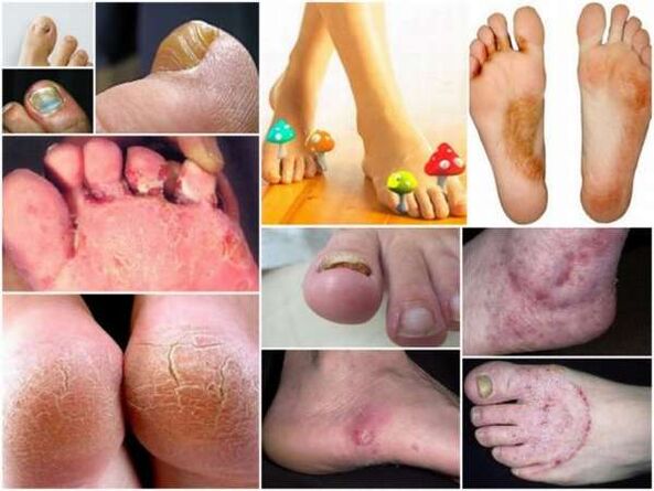 Manifestations de champignons sur les pieds
