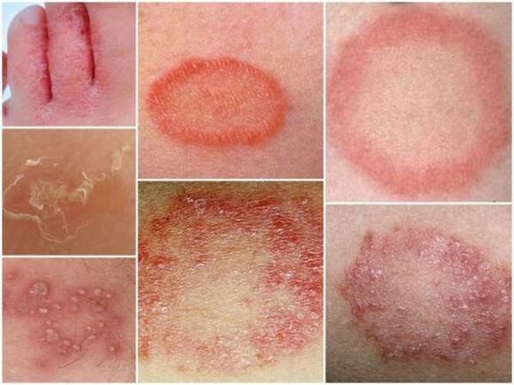 Teigne de la peau des jambes