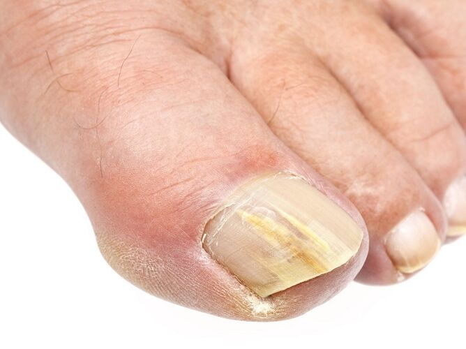 jaunissement de l'ongle dû à une infection fongique